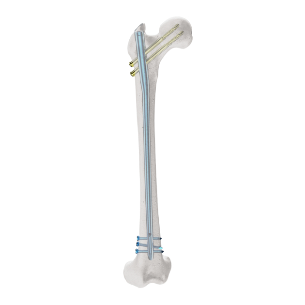 MR Femoral Nail