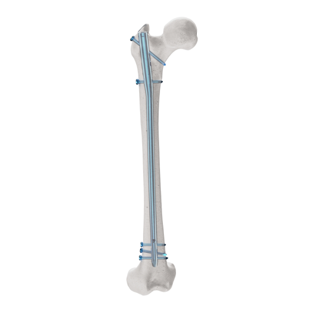 MR Femoral Nail