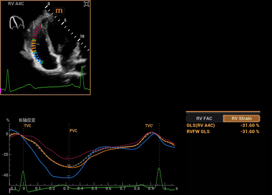 Recho R9 Automated Cardiac Function Analysis - Auto Strain RV