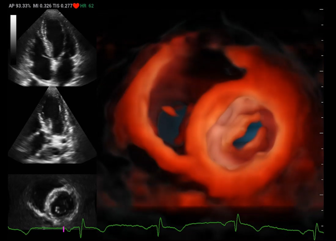 Recho R9 Real-time 3D Cardiac lmaging - iLive Echo image