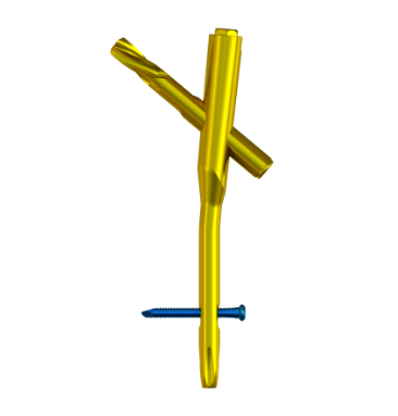 Intramedullary Nail